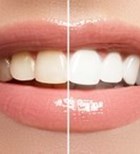 הלבנת שיניים ZOOM - תמונת אווירה